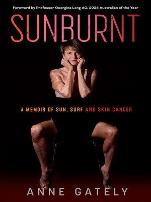 cover image of SUNBURNT